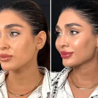تزریق چربی و لیپو ساکشن