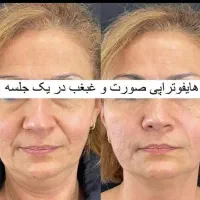 جشنواره لیفت/جوانسازی/انواع هایفو/در1جلسه فقط ۸۹۰ت|خدمات آرایشگری و زیبایی|اصفهان, ناژوان|دیوار