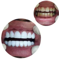 تخفیفات پاییزی کلینیک دیاموند|خدمات آرایشگری و زیبایی|زرندیه, |دیوار