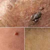 رفع دائمی و قطعی hpv زگیل و تبخال