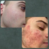 کرم جوان ساز، بیومیتیک، زد چروک