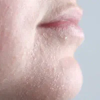 رهایی از خشکی پوست با جوانه گندم ویتابلا