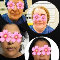 تخفیف ۵۰٪  برای تزریق چربی ژل فول فیس  ژل لب