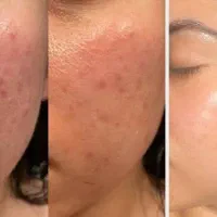 فیشیال و پاکسازی وجوانسازی پوست|خدمات آرایشگری و زیبایی|خوی, |دیوار