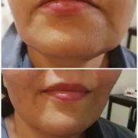 لیفت صورت و جوانسازی در یک جلسه