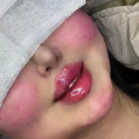 فیلر بادی ،تزریق ژل و بوتاکس با بهترین متریال قیمت|خدمات آرایشگری و زیبایی|دزفول, |دیوار