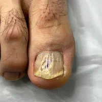 درمان بیماری های ناخن