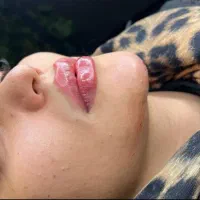 فیلر و نخ بوتاکس