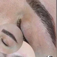 فیبروز،میکروبلیدینگ،شیدینگ لب