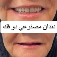 دندانسازی تخصصی ساخت دندان متحرک (اوردنچر)
