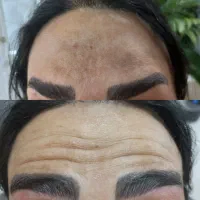 بوتاکس.فیلر.مزو.میدفیس