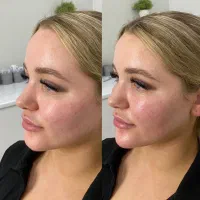 اف ۵۰٪ژل و بوتاکس و مزو...|خدمات آرایشگری و زیبایی|اهواز, اهواز|دیوار