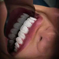کامپوزیت لبه شیشه ای لمینت روکش تمام سرامیکی