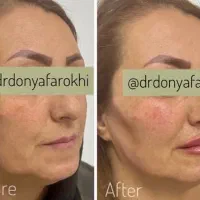 ژل بوتاکس لیزر لاغری مشاوره رایگان مطب دکتر فرخی|خدمات آرایشگری و زیبایی|اسلامآباد غرب, |دیوار