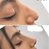 تزریقات زیبایی|خدمات آرایشگری و زیبایی|قرچک, مهدیه|دیوار