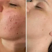 پک‌ضدجوش تضمینی