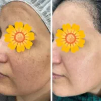 پی آر پی ،مزوتراپی،بوتاکس