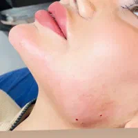جشنواره فیلر ژل بوتاکس لاغری فیشال