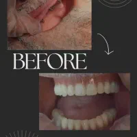 جشنواره کامپوزیت لمینیت عصب IPS IMAX روکش N2 ونیر|خدمات آرایشگری و زیبایی|تهران, هفت حوض|دیوار