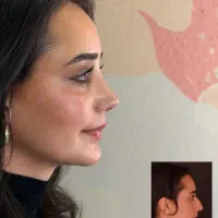 بینی طبیعی عمل در تهران
