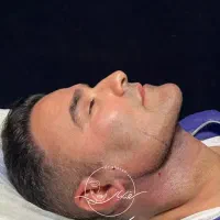 ساکشن غبغب بایوفیلر اگزوزوم پی آرپی