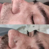 لیزر خال /میخچه زگیل/ ژل بوتاکس