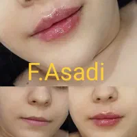 تزریق ژل و بوتاکس برای خانم ها و آقایان