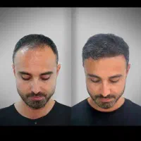 جشنواره کاشت مو دکتر راکعی .اقساط ۱۲ ماهه بدون سود|خدمات آرایشگری و زیبایی|اراک, |دیوار