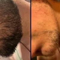 از کم پشتی به پرپشتی