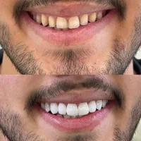 جشنواره دندان ونیر کامپوزیت روکش لمینیت عصب ترمیم|خدمات آرایشگری و زیبایی|تهران, هفت حوض|دیوار
