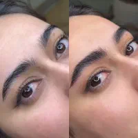 میکروبلیدینگ فیبروز باجدیدترین تکنیک تخفیف عیدانه