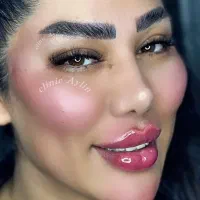 ژل لب فیلر بوتاکس مزو جوانسازی کانتوریگ لیفت نخ|خدمات آرایشگری و زیبایی|تهران, پونک|دیوار