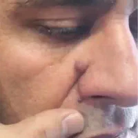 برداشتن انواع خال و زگیل در آرایشگاه