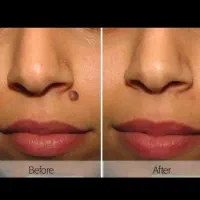 برداشتن خال ،زگیل ،پلکسر پلک.کوچک کردن بینی