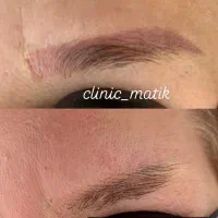 پاک کردن تاتو ابرو و بدن با دستگاه