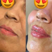 تزریق فیلر بادی و فول فیس