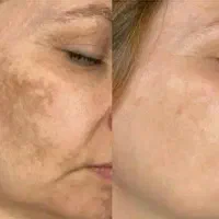 حذف کک و مک|خدمات زیبایی و سلامت|اصفهان, هزارجریب|دیوار