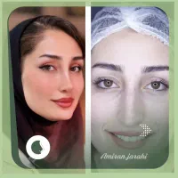 عمل بینی/جراحی بینی