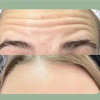 تزریق بوتاکس مصپوت فقط۷۰۰ تومان