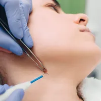 برداشت زگیل و خال و زگیل تناسلی با لیزر اقا وخانم|خدمات آرایشگری و زیبایی|تهران, قیطریه|دیوار