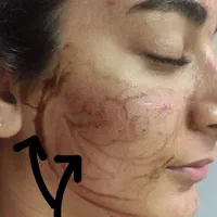 خالبرداری پلاسما درمان ککُ مک و منافذ فیشیال تخصصی|خدمات آرایشگری و زیبایی|مرودشت, گندم‎|دیوار