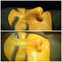 شرایط ویژه جراحی زیبایی بینی بهاره