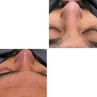 پی آرپی و مزوتراپی|خدمات آرایشگری و زیبایی|مشهد, نیروی هوایی|دیوار