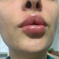 ژل و بوتاکس