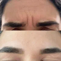 بوتاکس،فیلر،هایفو با تخفیف سال نو