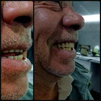 دندان مصنوعی(بدون واسطه خرید کن)|خدمات آرایشگری و زیبایی|قرچک, باقرآباد|دیوار