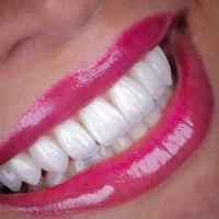 آف ویژه خدمات دندانپزشکی/وایمپلنت17800 بدون پیش