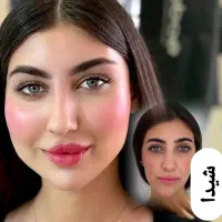 تزریق ژل و فیلر فقط۳۰۰هزار