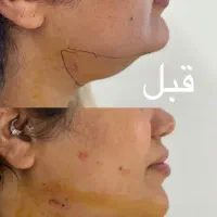 تزریق ژل بوتاکس ساکشن غبغب نخ لیفت توسط پزشک|خدمات آرایشگری و زیبایی|کرج, گلشهر|دیوار