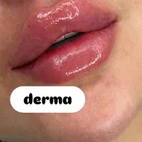 تزریق فیلر ژل/بوتاکس/prp پوست مو/پی آر‌پی/مزوتراپی|خدمات آرایشگری و زیبایی|کرج, گوهردشت|دیوار
